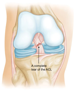 ACL injury